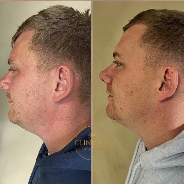 Hage i profil før og efter fedtfrysning