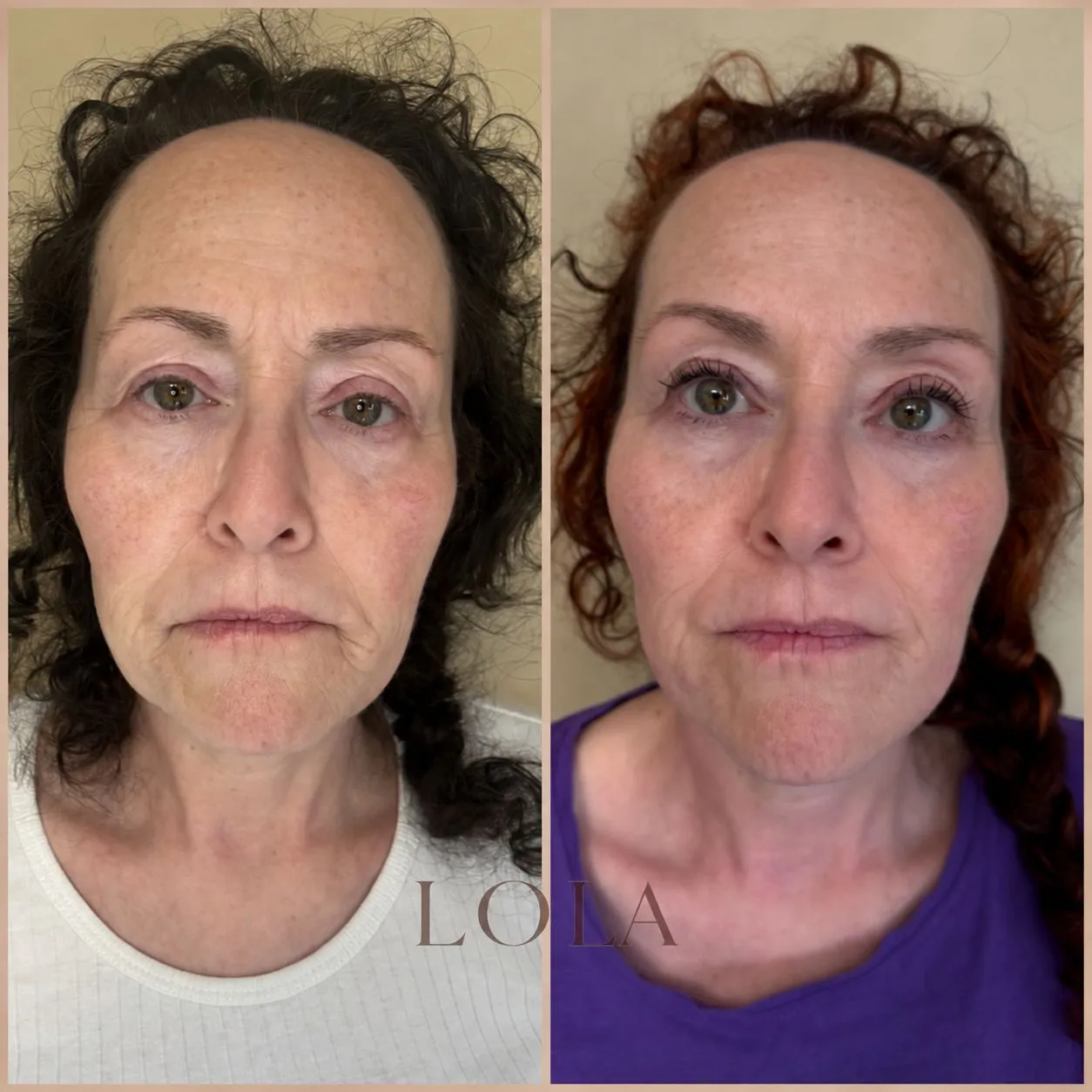 Ansigt forfra før og efter botox