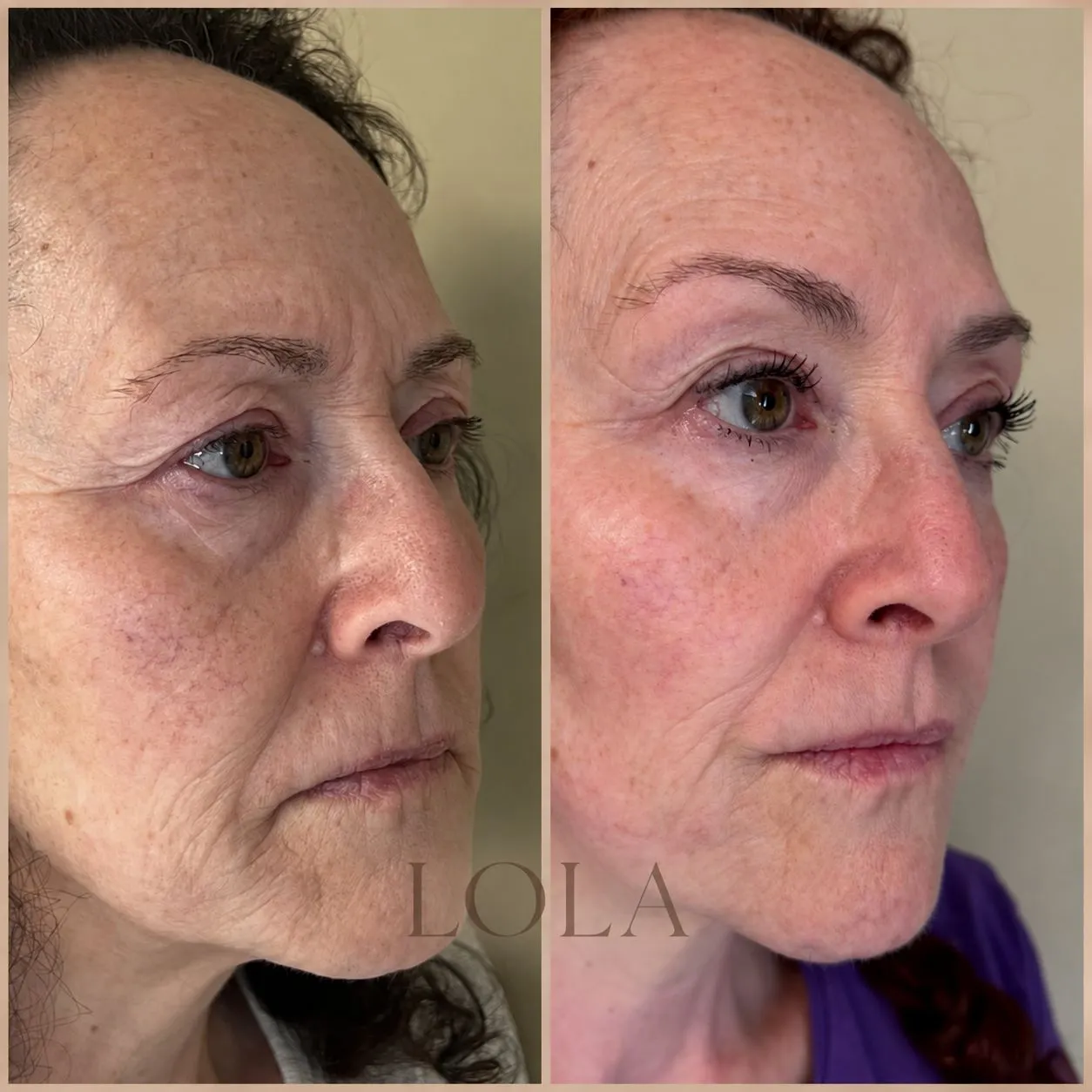 Ansigt skråt fra siden før og efter botox