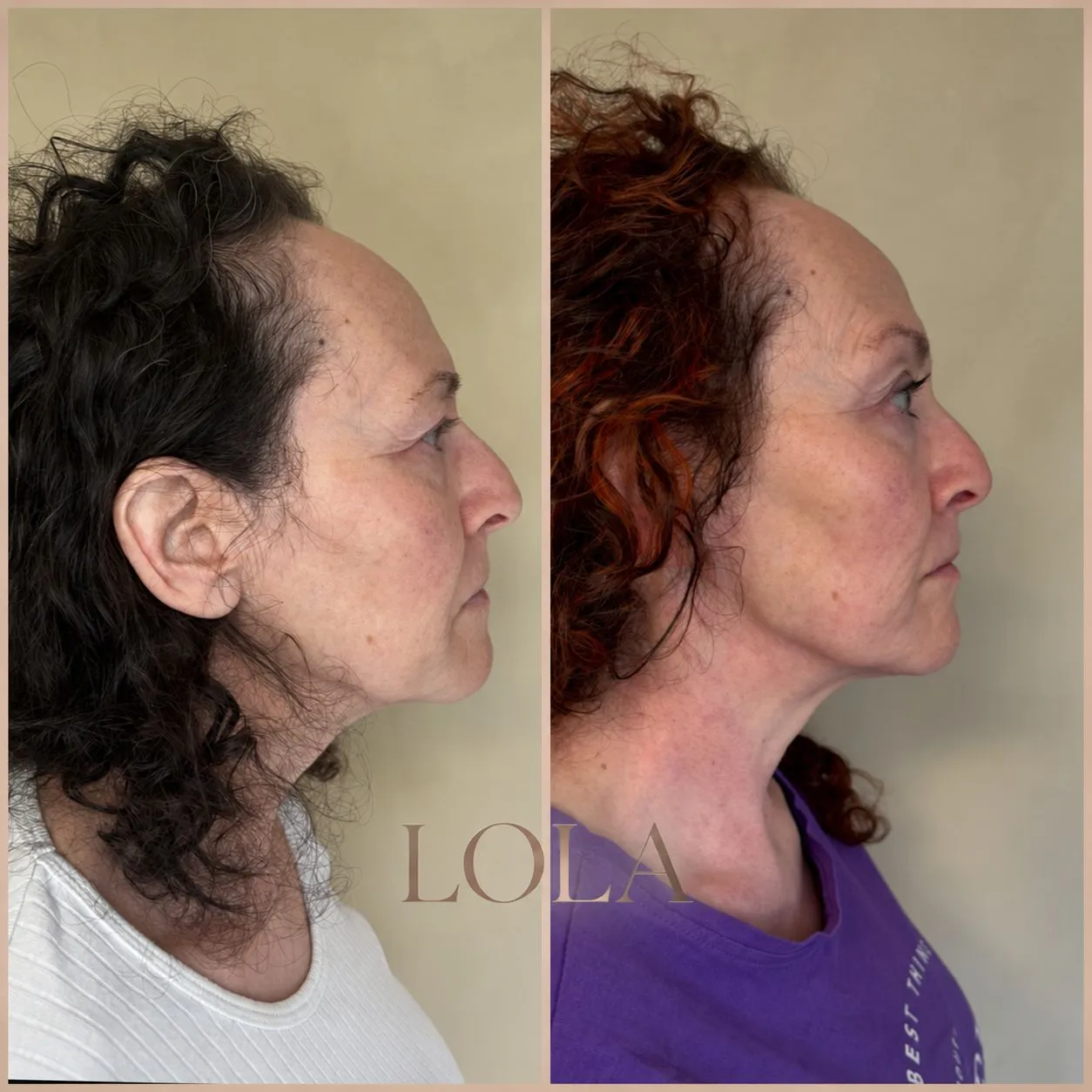 Ansigt i profil før og efter botox