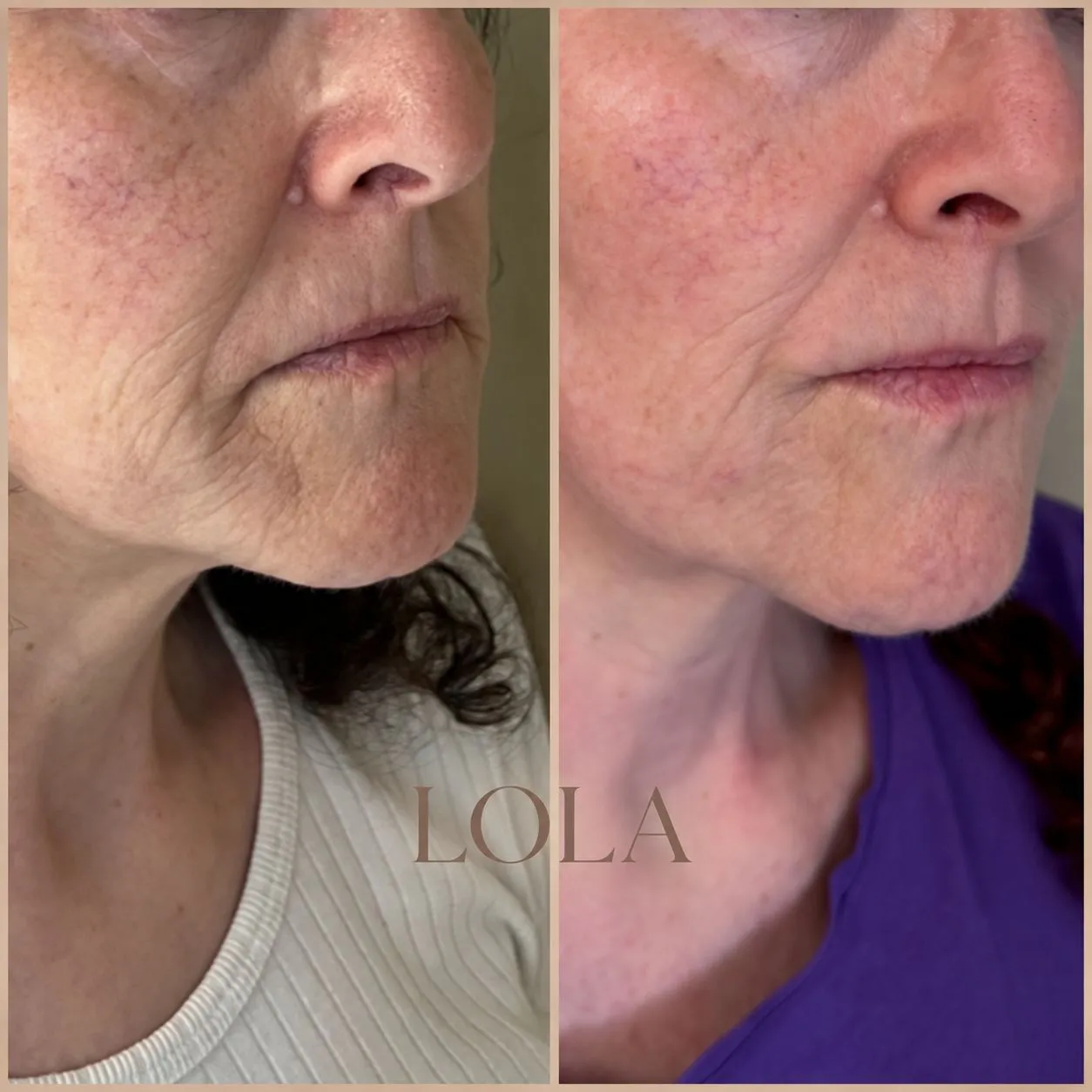 Nedre ansigt før og efter botox
