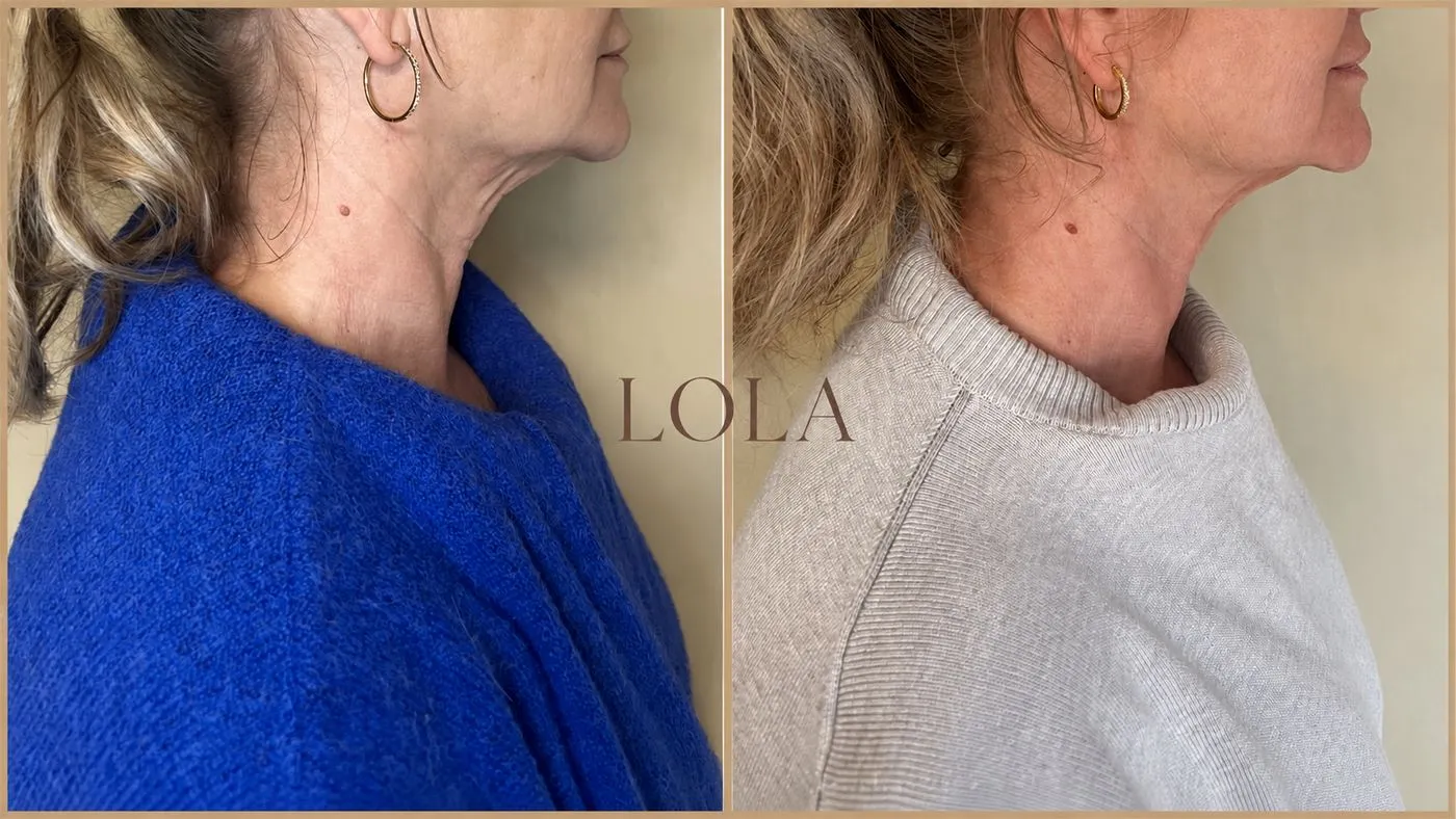 Hals i profil før og efter botox