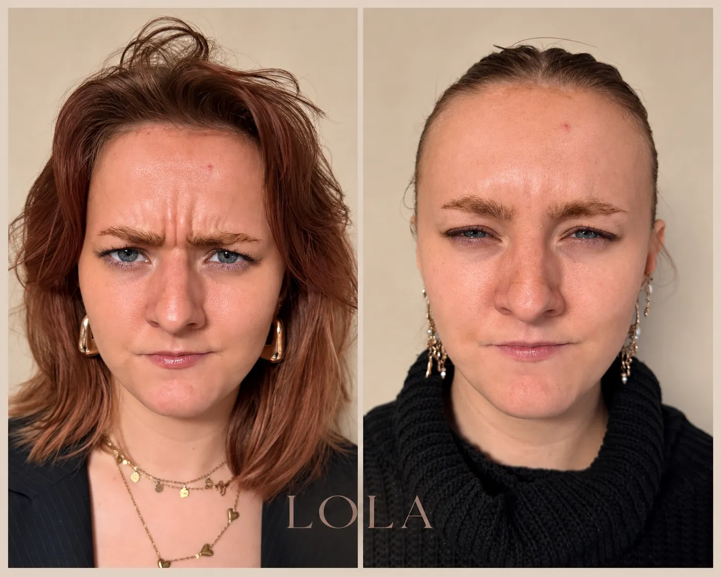 Pande forfra før og efter botox mod bekymringsrynker