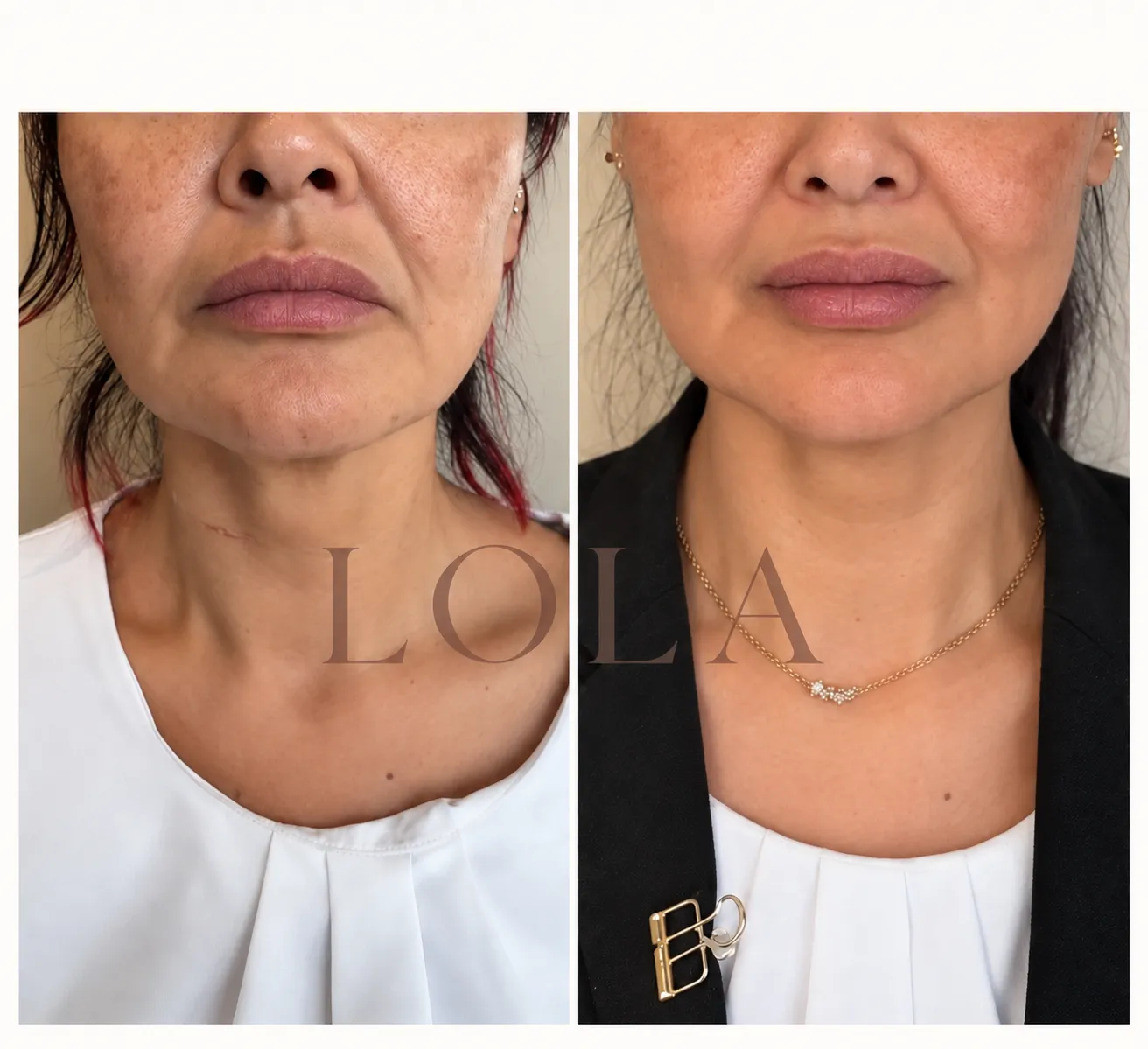 Hage og mundvige før og efter botox mod nedadgående mundvige