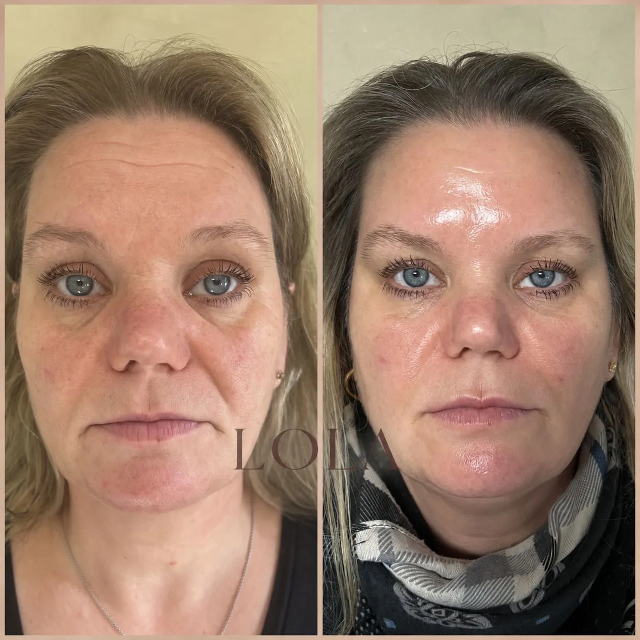 Ansigt forfra før og efter kombinationsbehandling med botox og filler