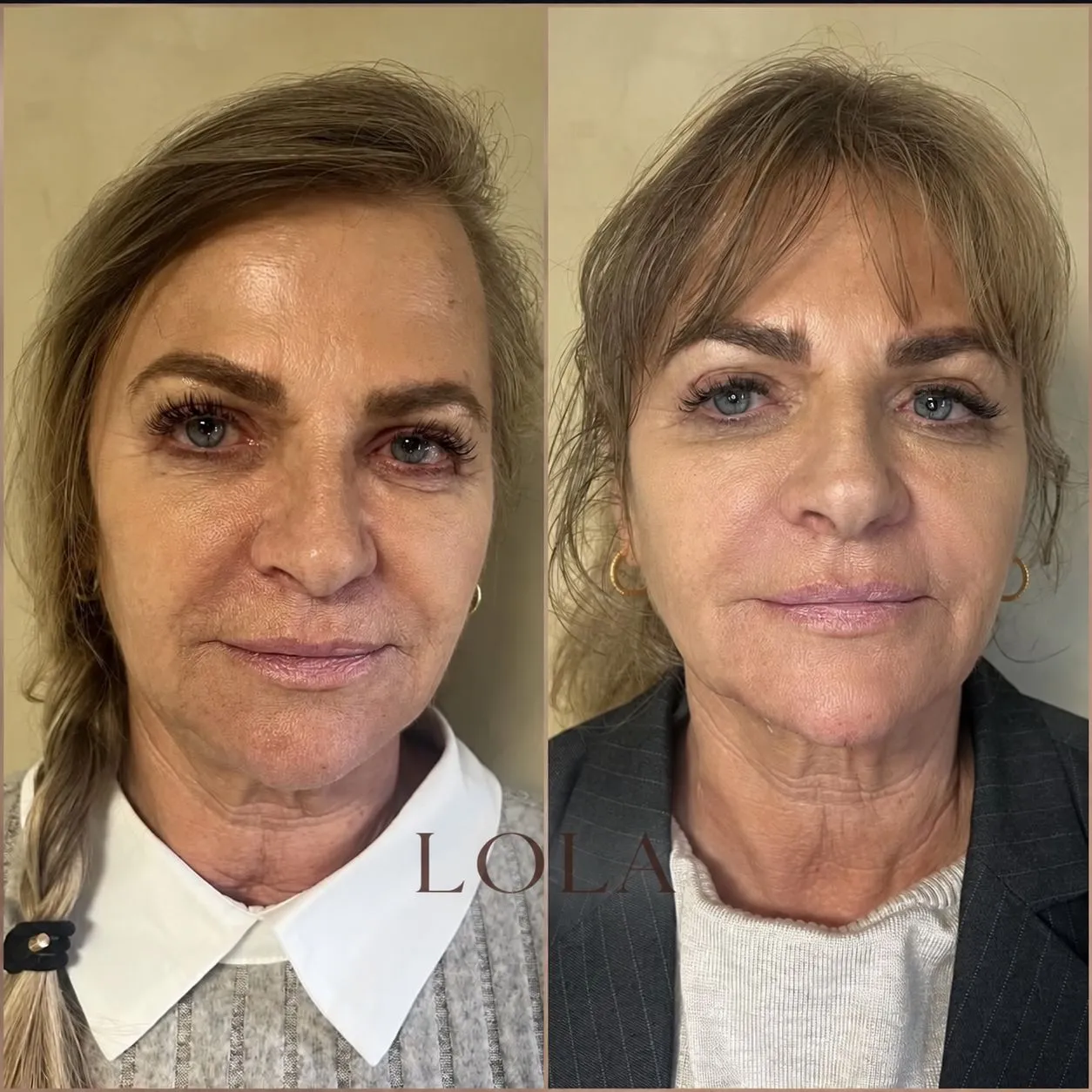 Ansigt forfra før og efter kombinationsbehandling med botox og filler