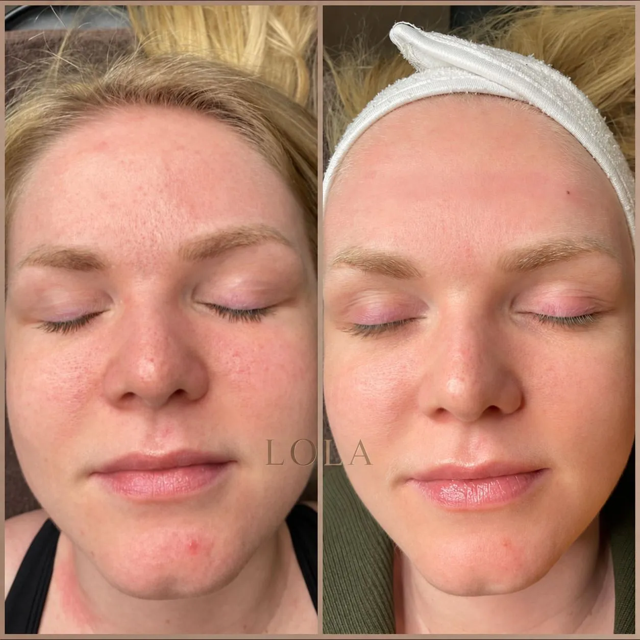 Ansigt før og efter Skin renewal