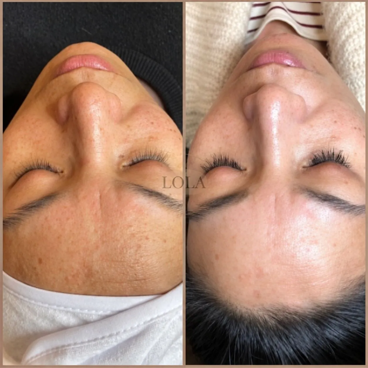 Ansigt før og efter Skin renewal