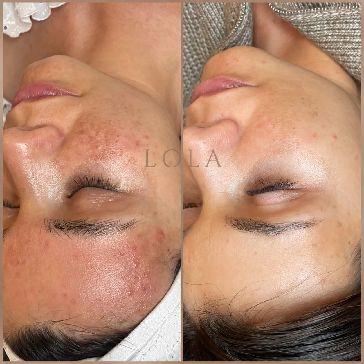 Kind før og efter Skin renewal