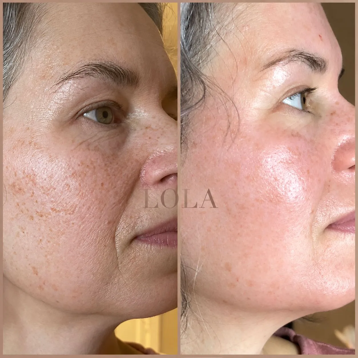 Ansigt fra siden før og efter Skin renewal