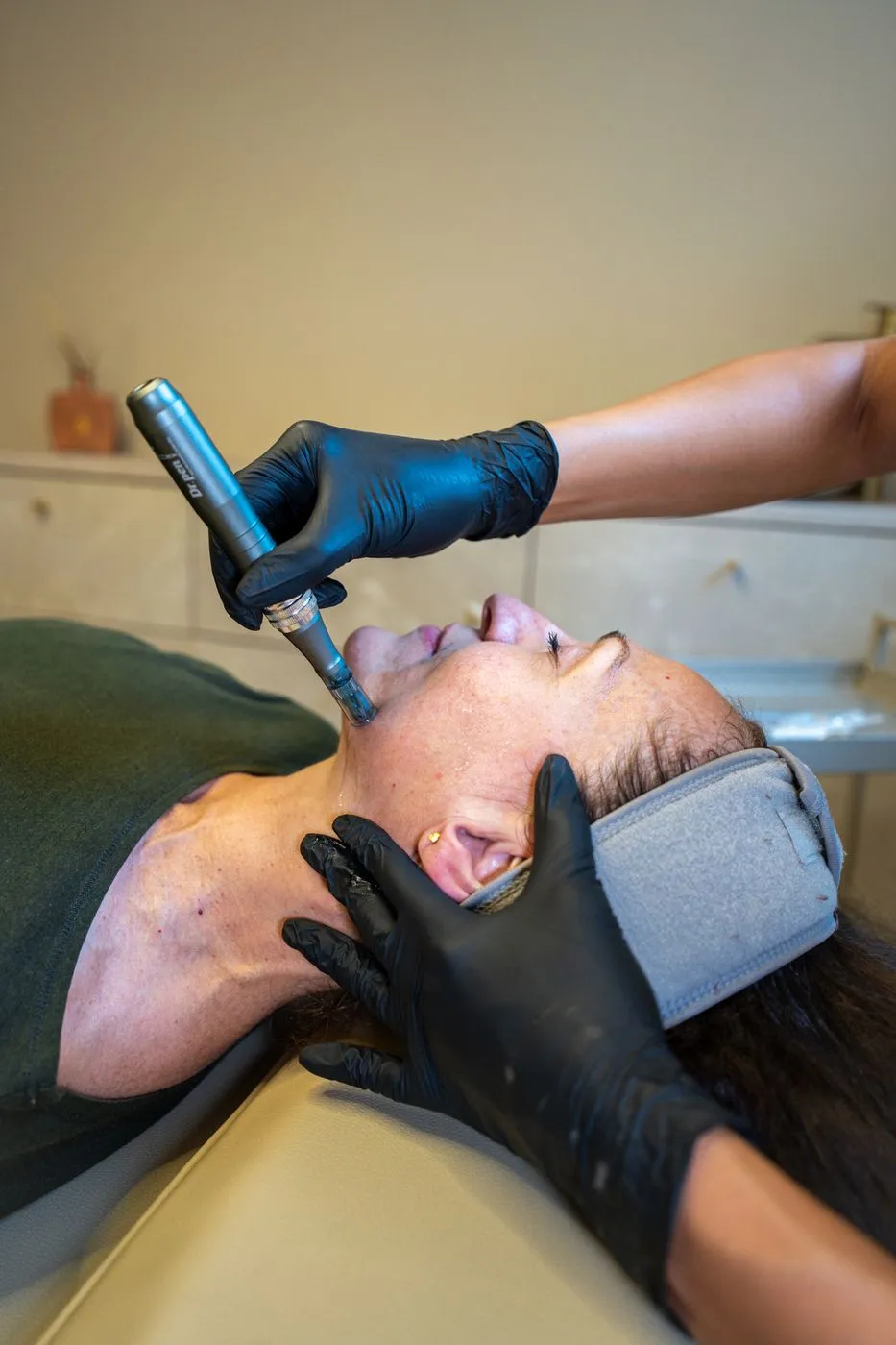 Behandler udfører microneedling i en klients ansigt