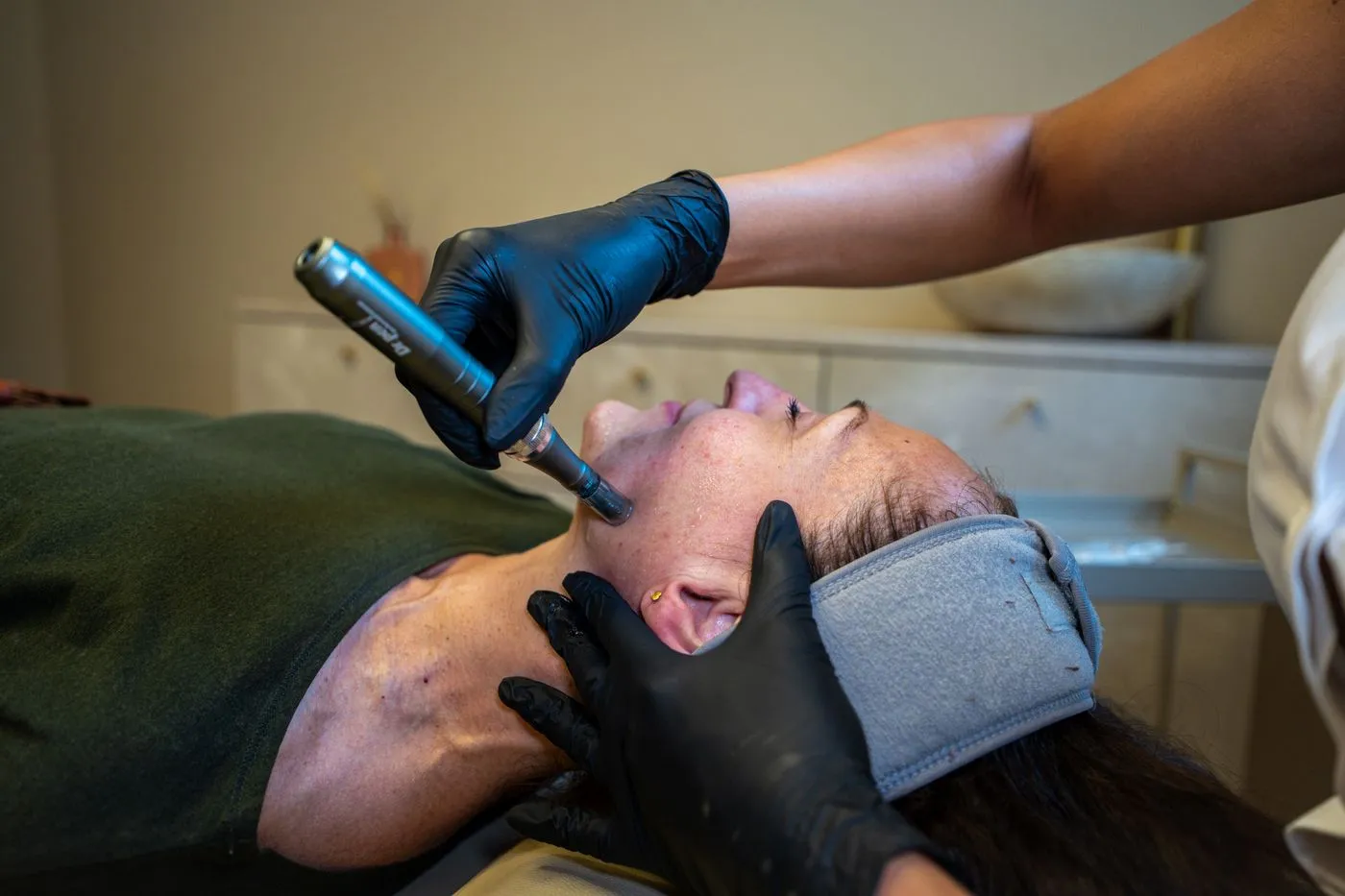Behandler udfører microneedling i en klients ansigt